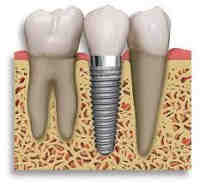 What does hip plus cover for dental?