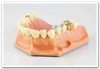 What happens when a dental implant crown breaks?