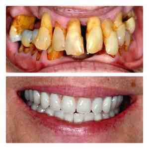 What happens when a dental implant is loose?