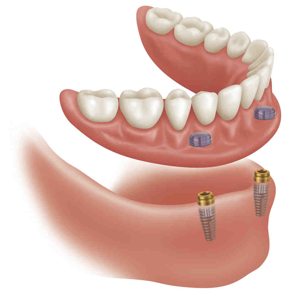 What is a contraindication for considering a patient for dental implants?