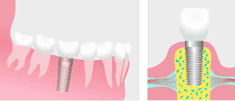 What is a dental implant procedure