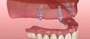 What is a reasonable price for dental implants?