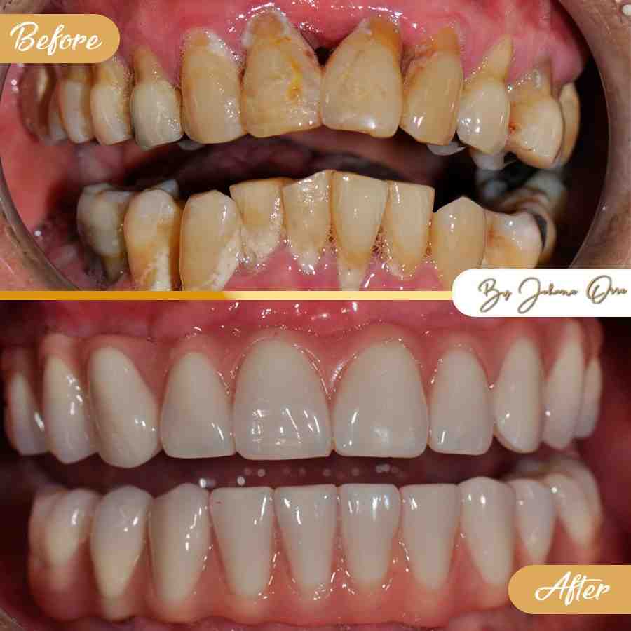 What is a reasonable price for dental implants?