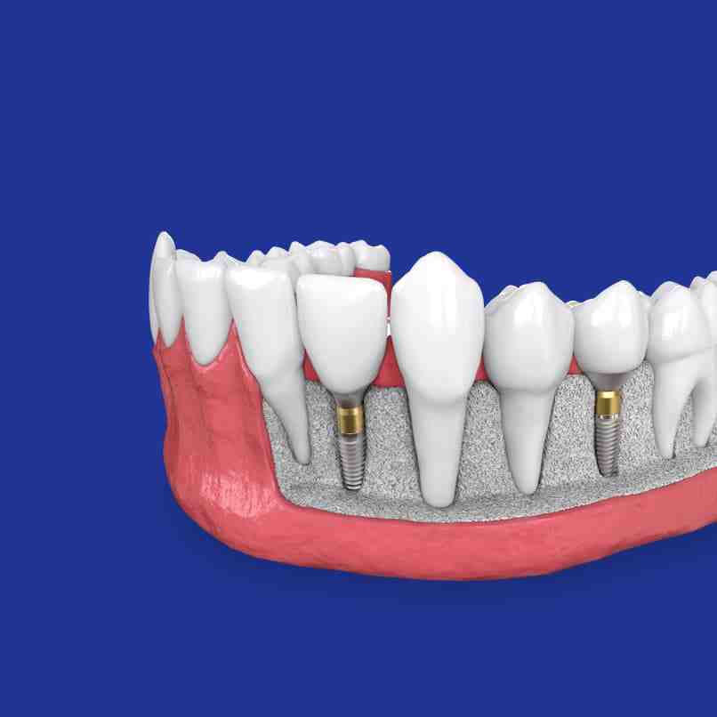 What is a reasonable price for dental implants?