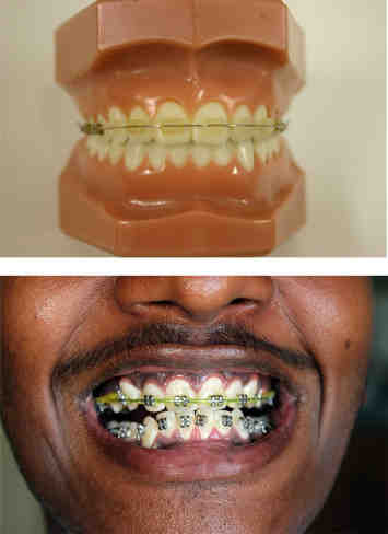 What is bad about dental implants?