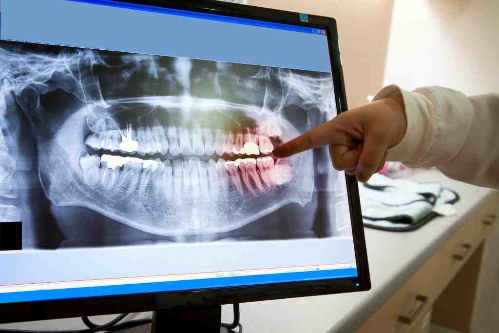 How to identify dental implants by x ray Dental News Network