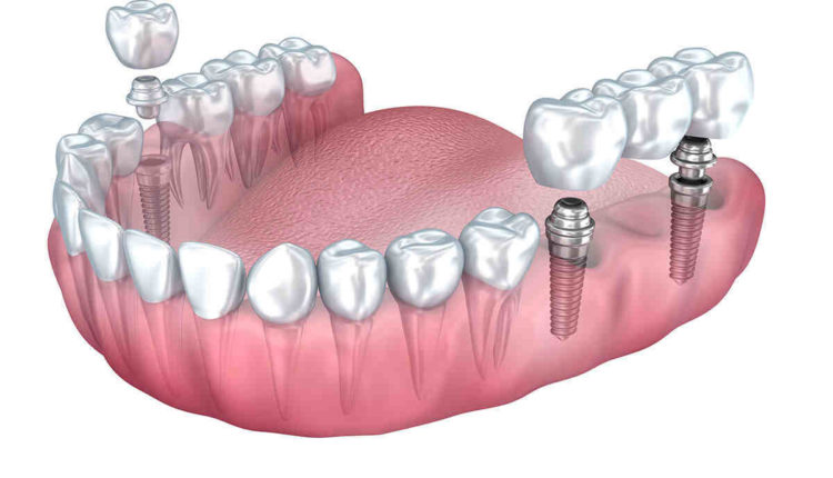 What is the average cost of full dental implants