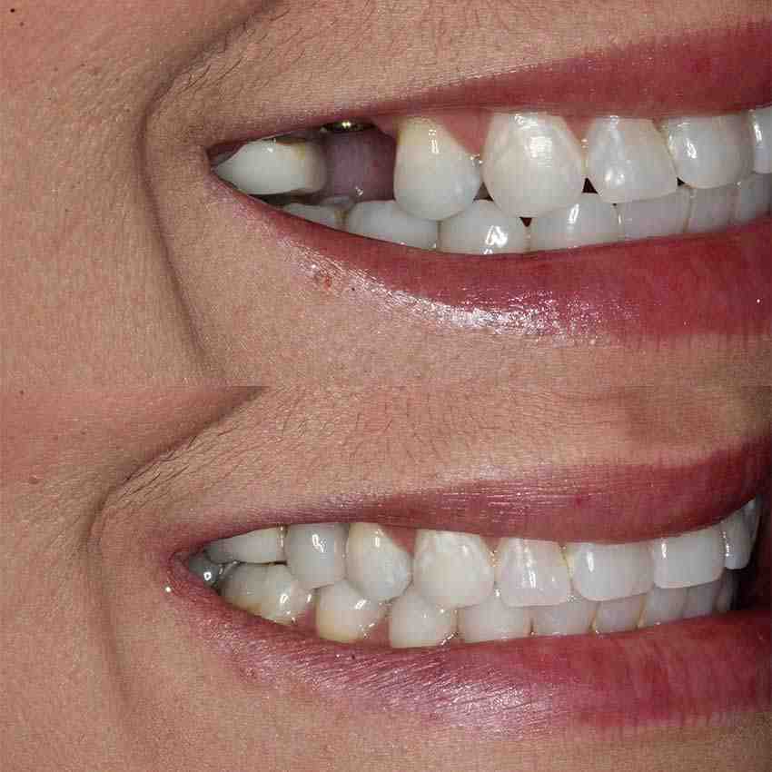 What is the average cost of one dental implant?