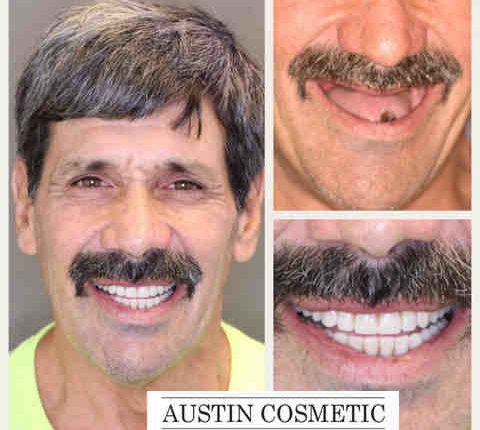 What is the average price for dental implants