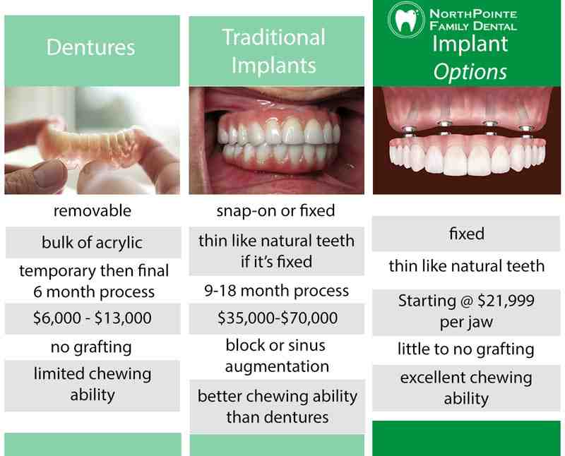 What Is The Average Price For Full Mouth Dental Implants 2 