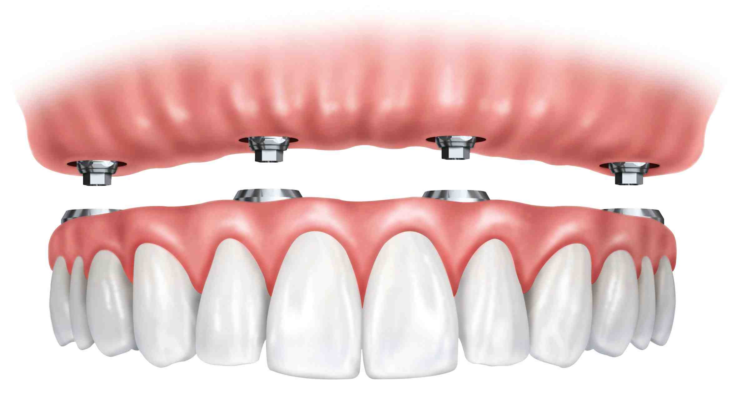 What is the average price for full mouth dental implants?
