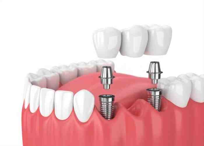What is the best alternative to dental implants?