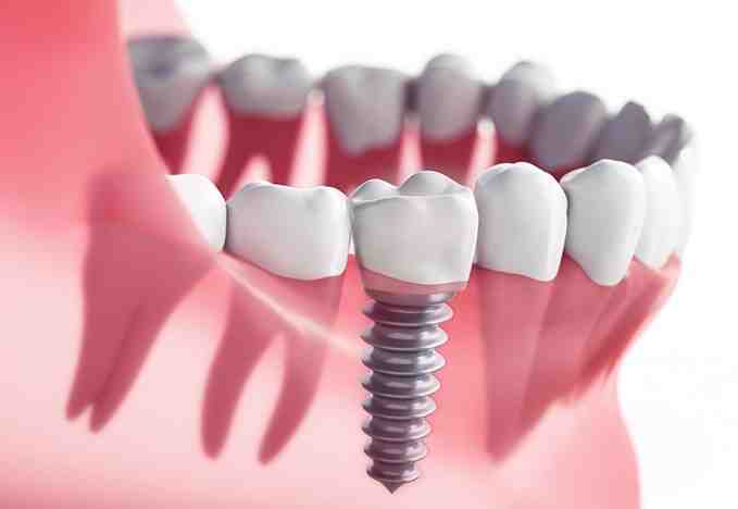 What is the best alternative to dental implants?