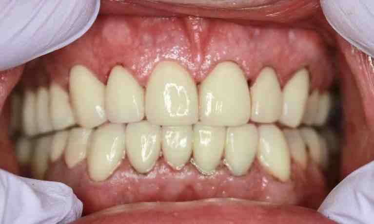 What is the best cosmetic dental procedure?