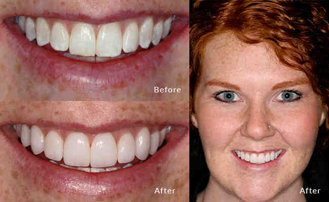 What is the best cosmetic dental procedure?