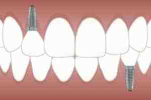 What is the best country to get dental implants?