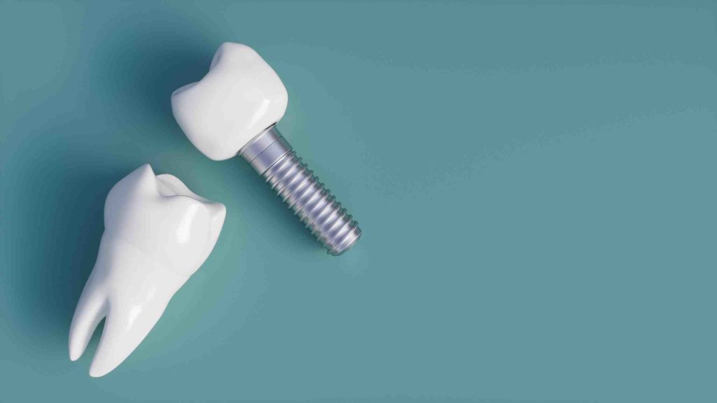 What dental insurance covers dental implants Dental News Network