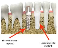 What is the best material to use for dental implants?