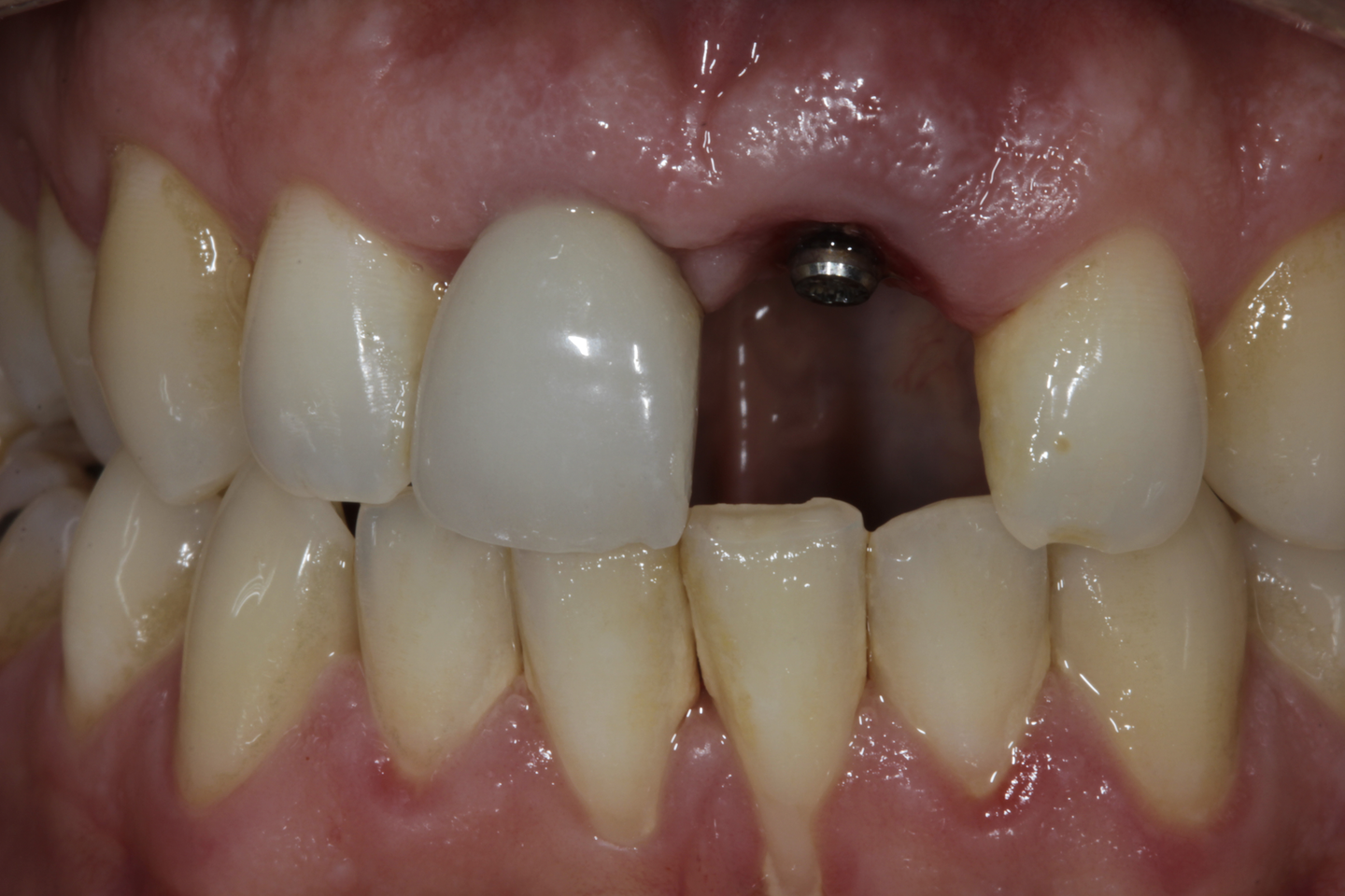 What is the best material to use for dental implants?