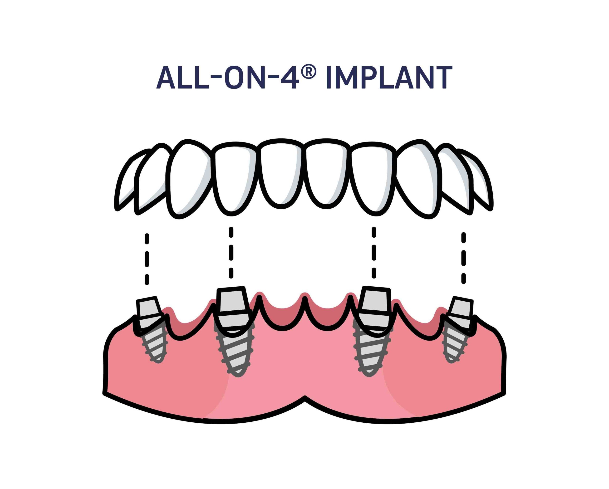 What is the best option for replacing missing teeth?