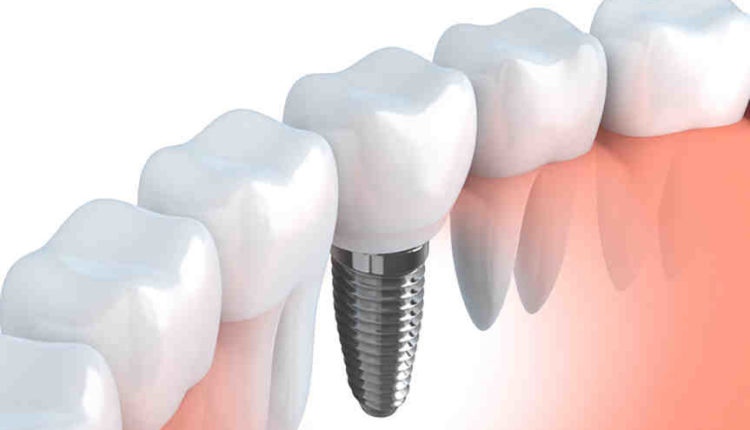 What is the cost of dental implants for the back top two teeth