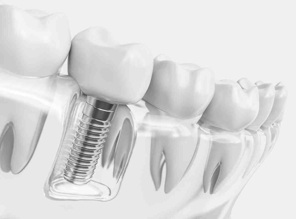 What is the downside of dental implants?