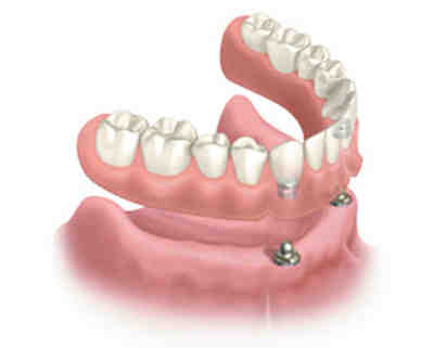 What is the downside of dental implants?