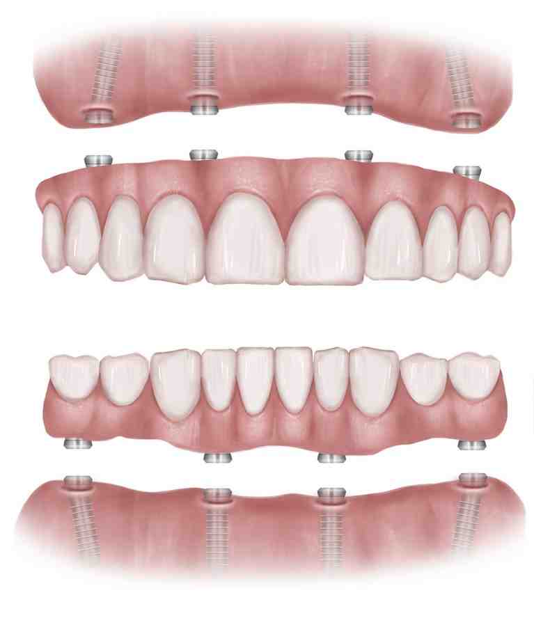 What is the downside of dental implants?