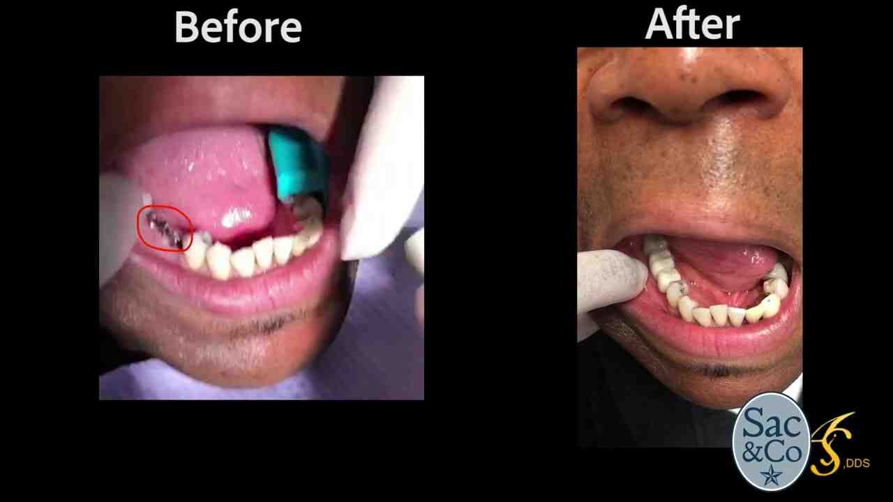 What is the downside of dental implants?