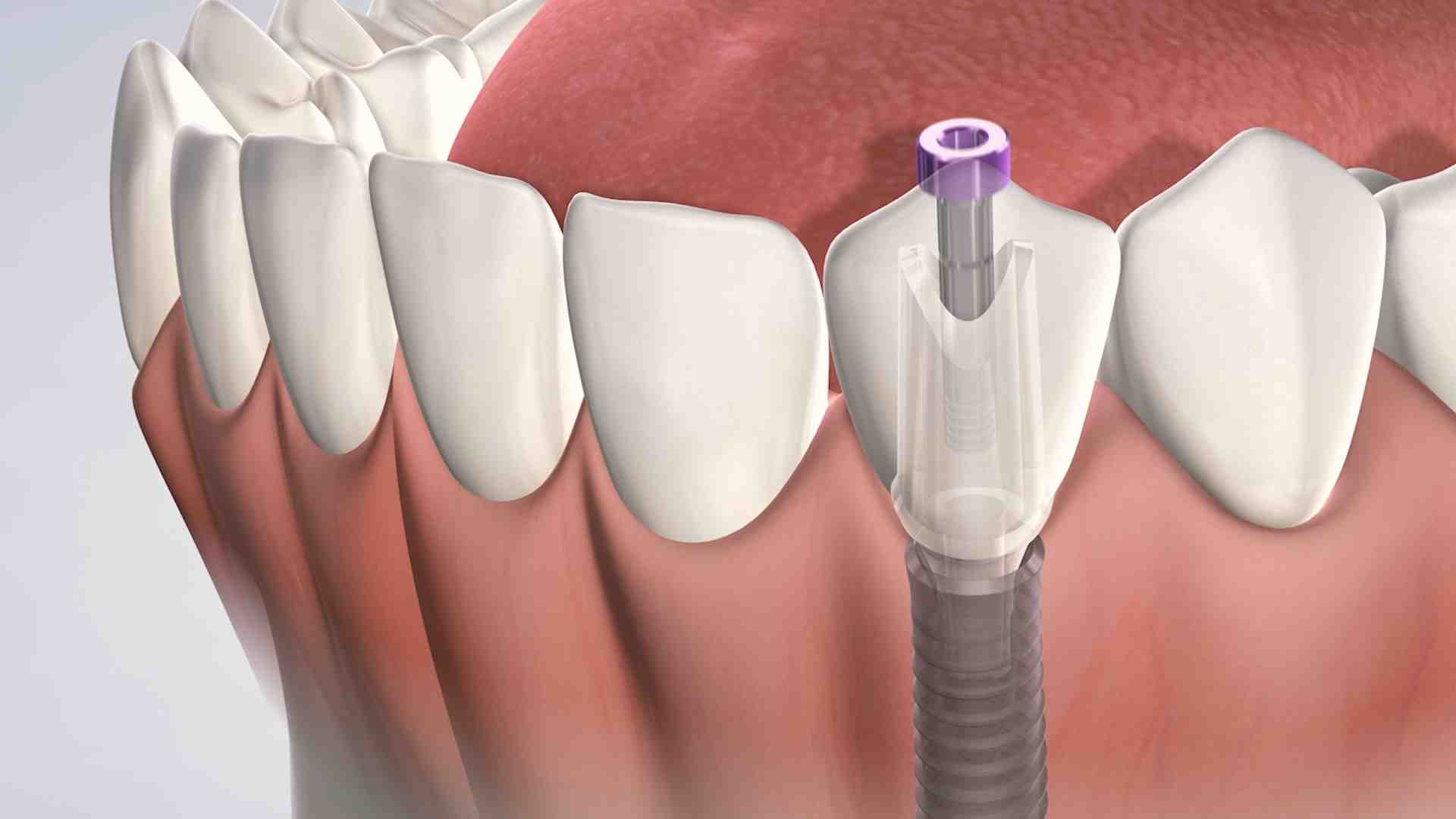 What is the downside of dental implants?