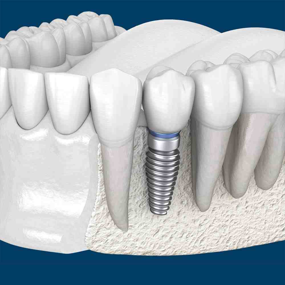 How successful are dental implants - Dental News Network