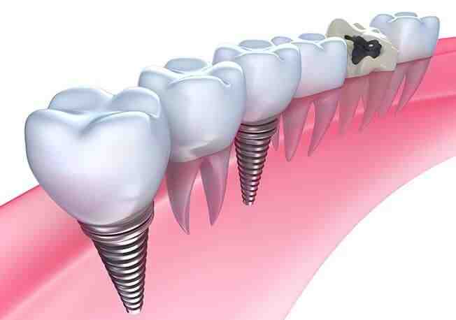What is the latest in dental implants?