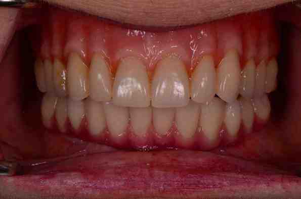 What is the procedure for all on 4 dental implants?