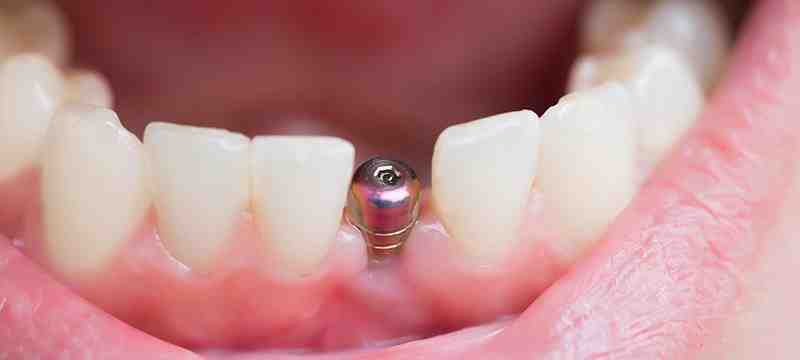 What is the success rate of mini dental implants?