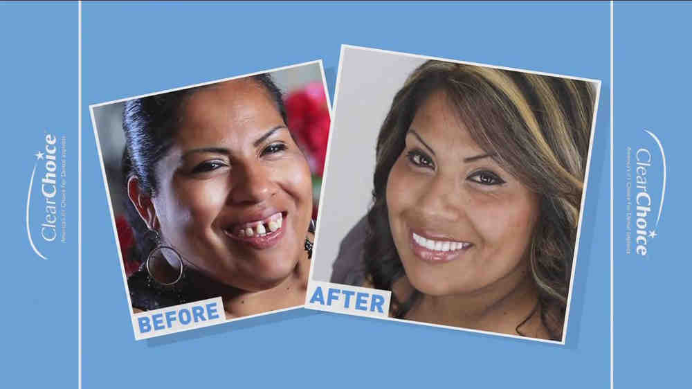 What kind of implants does clear choice use?