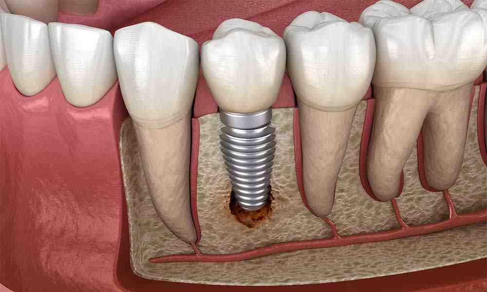 What percentage of dental implants are successful?