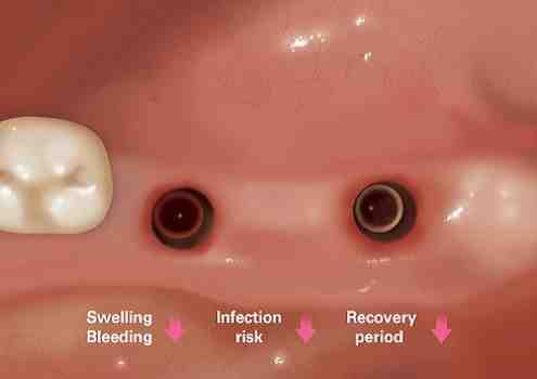 What should I do after dental implant?