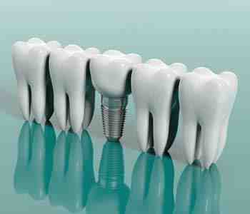 What to do if you can't afford dental implants?