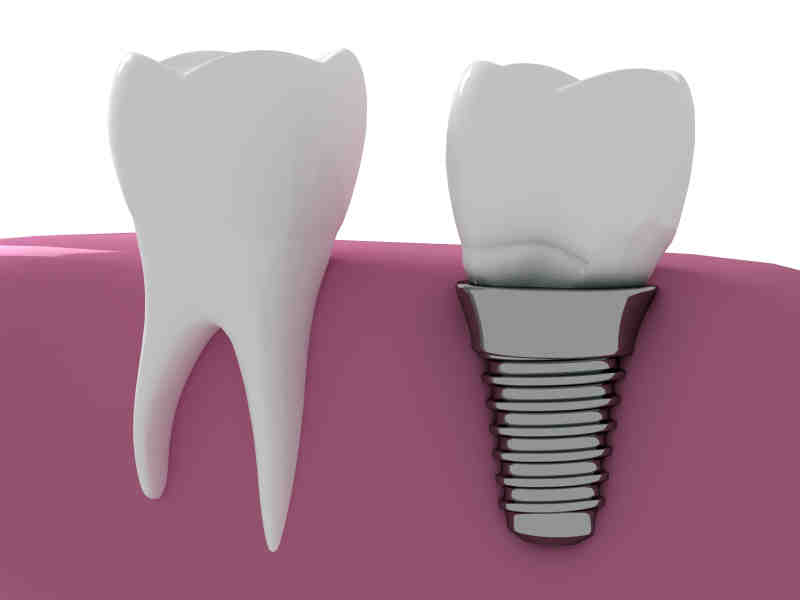 What to do if you can't afford dental implants?