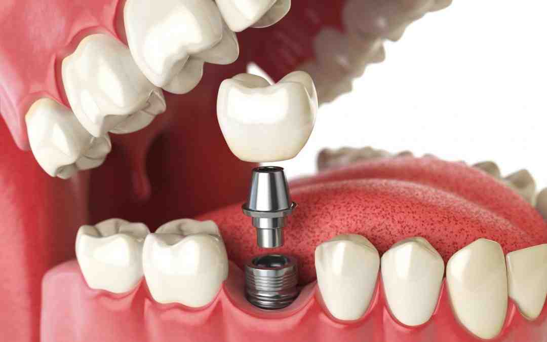 What to do if you can't afford dental implants?
