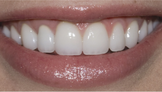 What to do when you can't afford dental implants?