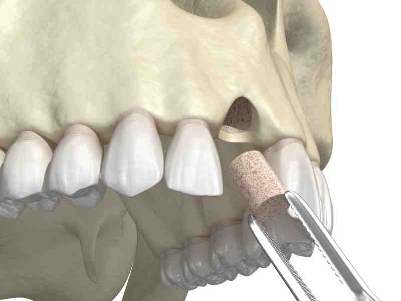 when-are-dental-implants-necessary-dental-news-network