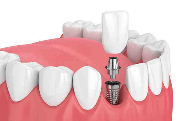 When did dental implants become available?