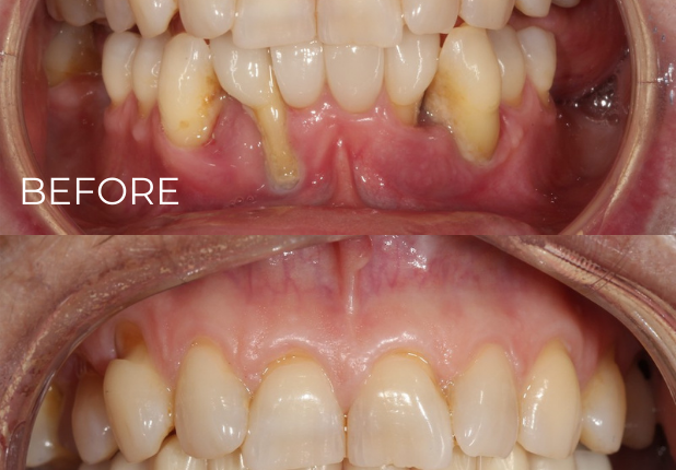 Who is not a good candidate for dental implants