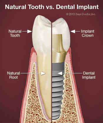 Who is not a good candidate for teeth implants?