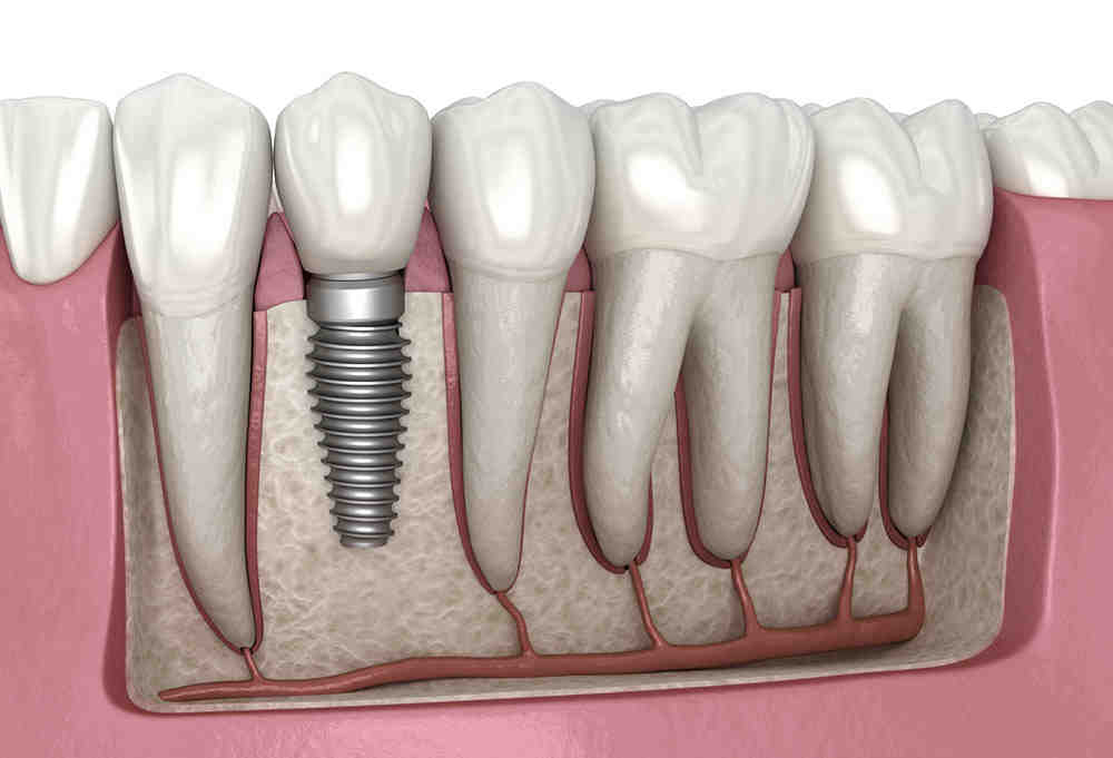 Who is not suitable for dental implants?