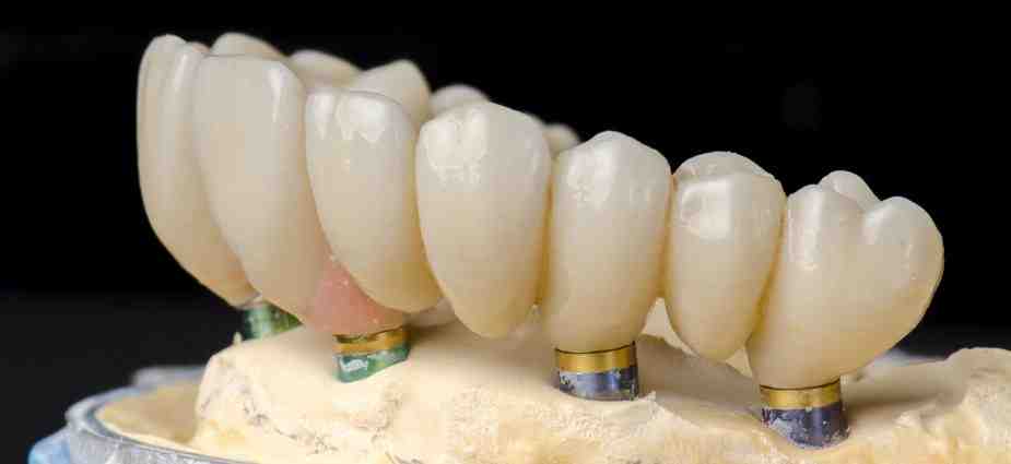 Who is not suitable for dental implants?