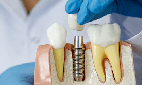 Who is not suitable for dental implants?