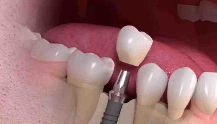 Who should do dental implants