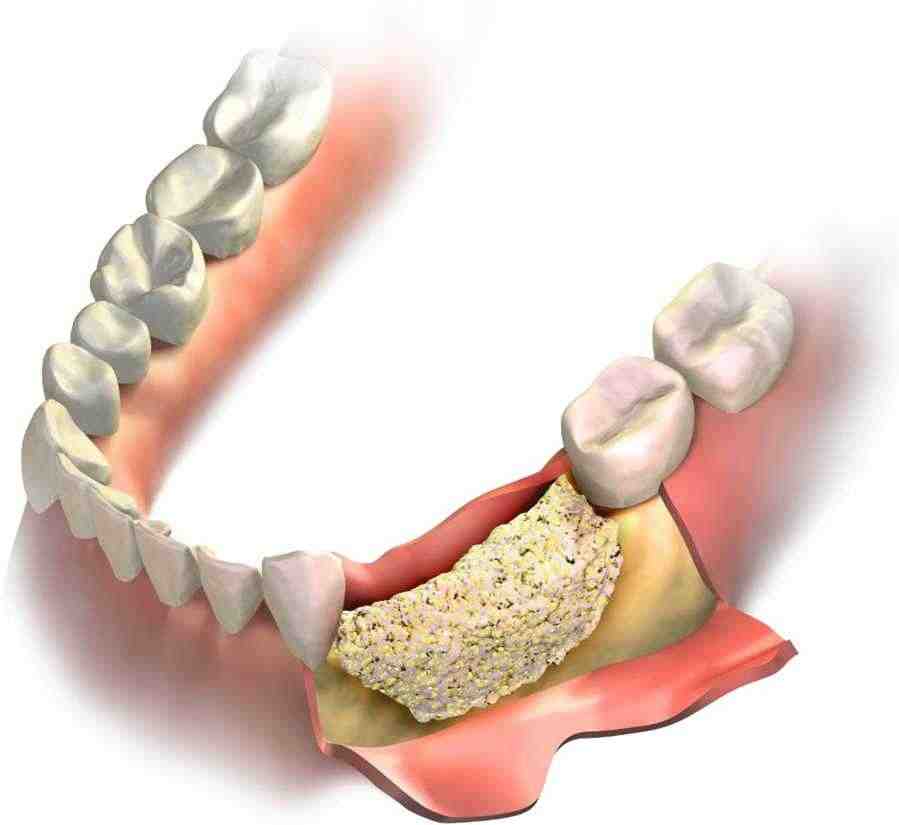 Who should not get dental implants?
